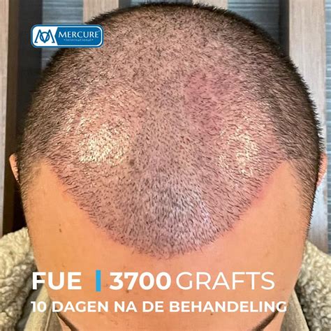 De Rol Van Saffier FUE In De Moderne Haartransplantatie