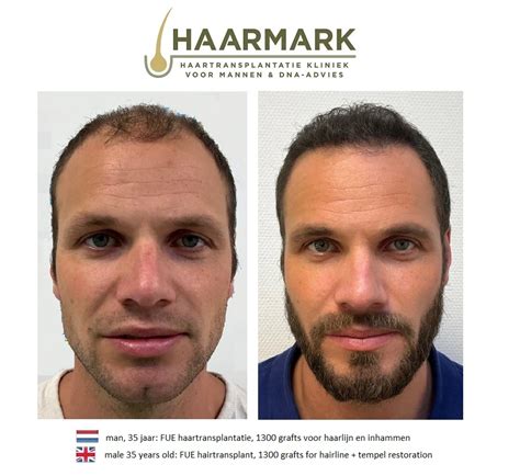 Haartransplantatie Voor En Na: Klantverhalen