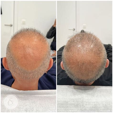 Haartransplantatie Voor En Na: Werkelijke Resultaten