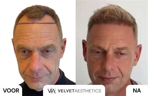 Hoe Kies Je De Beste Kliniek Voor Haartransplantatie?