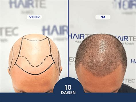 Hoe Lang Blijft Een Haartransplantatie Resultaat?