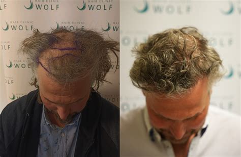 Hoe Te Kiezen Tussen Haartransplantatie DHI En FUE?