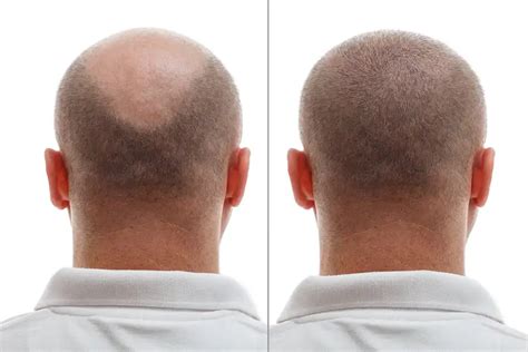 Voordelen Van Haartransplantatie DHI